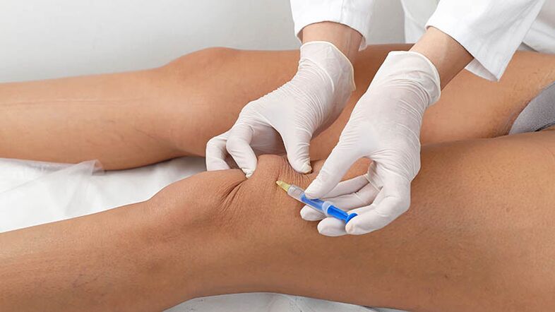 Intra -articular injection for knee osteoarthritis