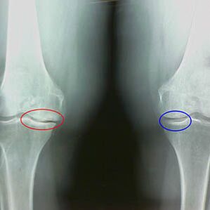 Knee joint osteoarthritis on the radiography