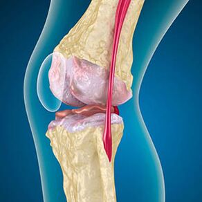 The excessive tension of the thigh muscle causes knee pain