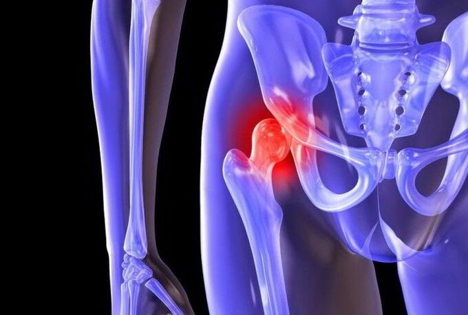 Pathological process in the hip joint with coxarthrosis.