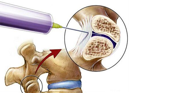 Paravertebral block for back pain.